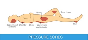 How to care for pressure sores Information