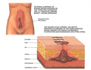 Surgical Wound Dehiscence: Causes, Risks, and Management