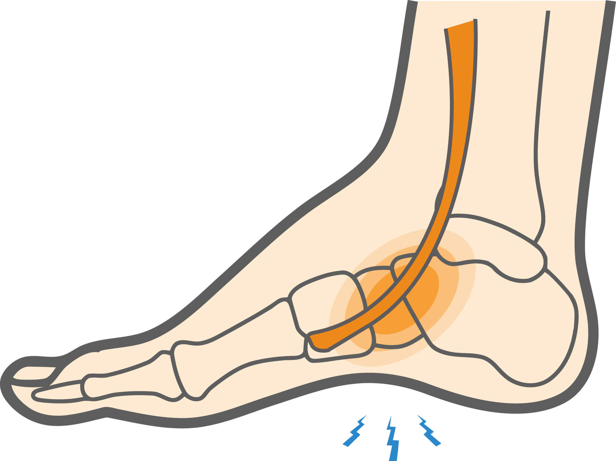 What Is Extensor Tendonitis in the Foot? - DFW Wound Care Center