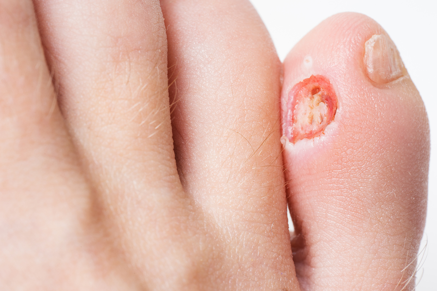 Nail diseases chart: Pictures, symptoms, and treatments