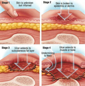 Briefs for Pressure Ulcer (Bedsore) Prevention