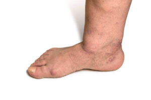 Can Charcot Foot In The Diabetic Be Reversed?