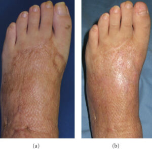 Before and after skin graft